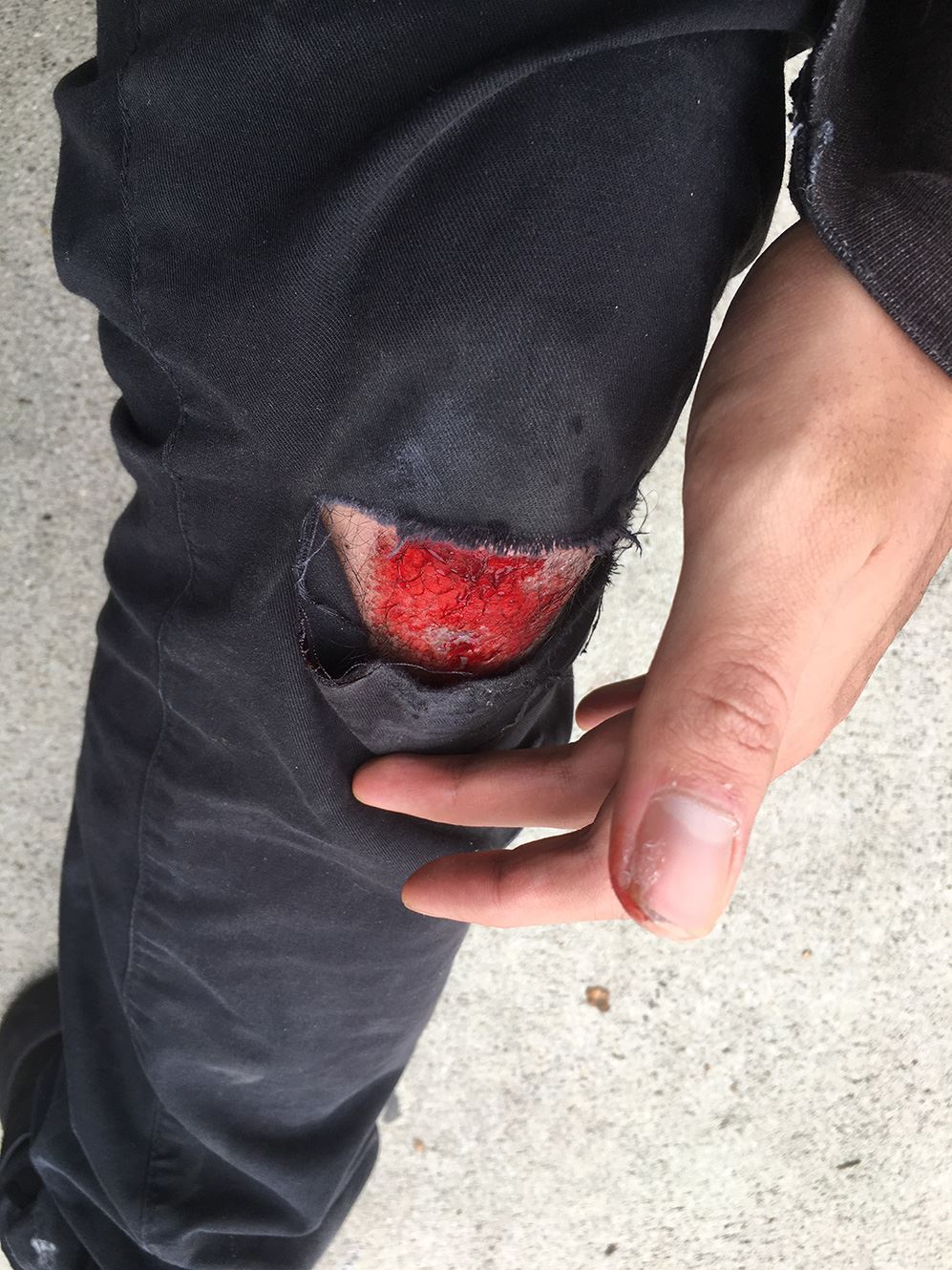 Scraped knee from Lyft scooter accident